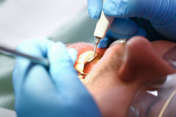 Best Emergency Wisdom Teeth Removal in Dillonvale, OH